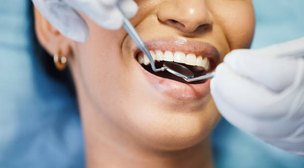 Best Chipped Tooth Repair Near Me  in Meadowbrook, CA