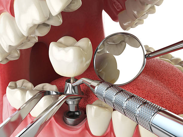 Best Urgent Tooth Repair  in Meadowbrook, CA